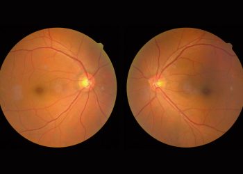 Tomografía de coherencia óptica en el tratamiento de la retinopatía diabética