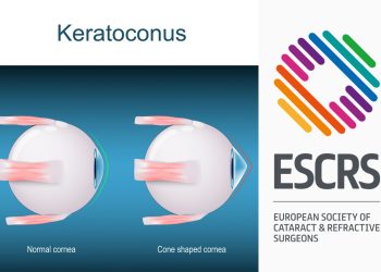 IA ayuda a prevenir pérdida de visión por queratocono