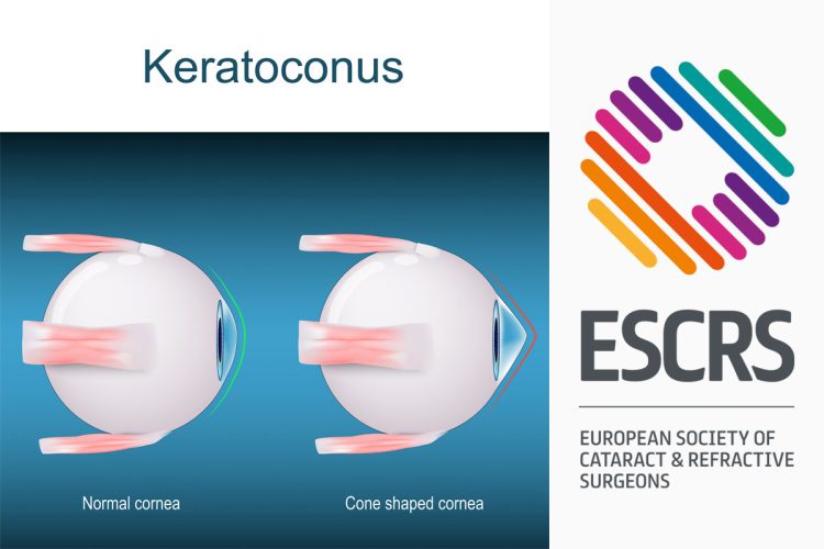 IA ayuda a prevenir pérdida de visión por queratocono
