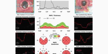 Diagnóstico del glaucoma en pacientes con miopía alta
