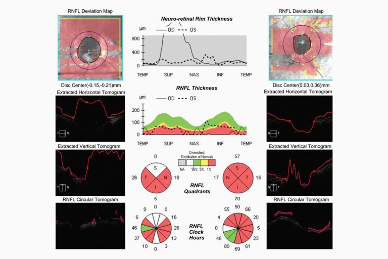 Diagnóstico del glaucoma en pacientes con miopía alta