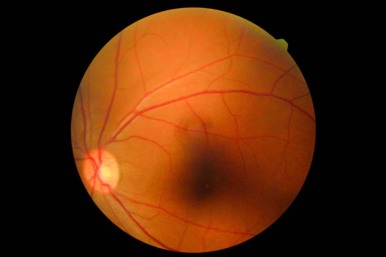 Uveítis recurrente: una revisión para especialistas en retina