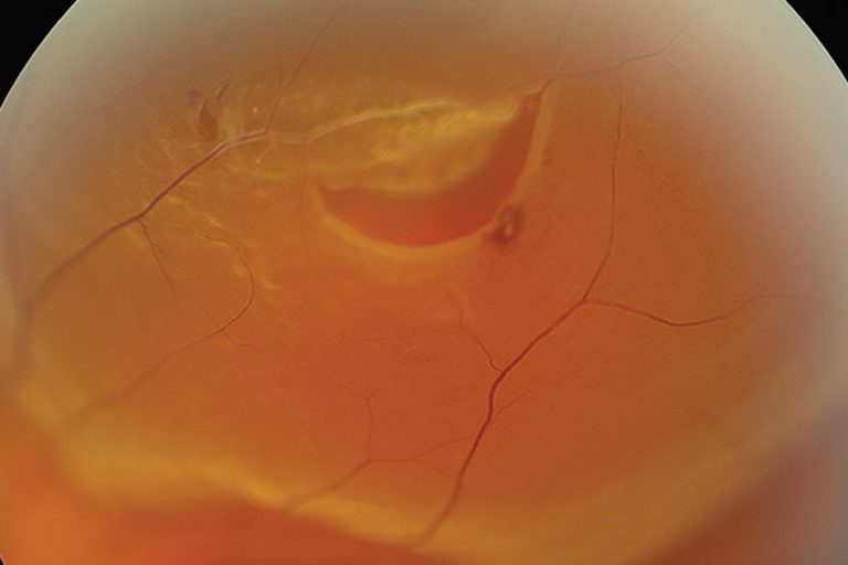 Estudio confirma estabilidad visual tras desprendimiento de retina