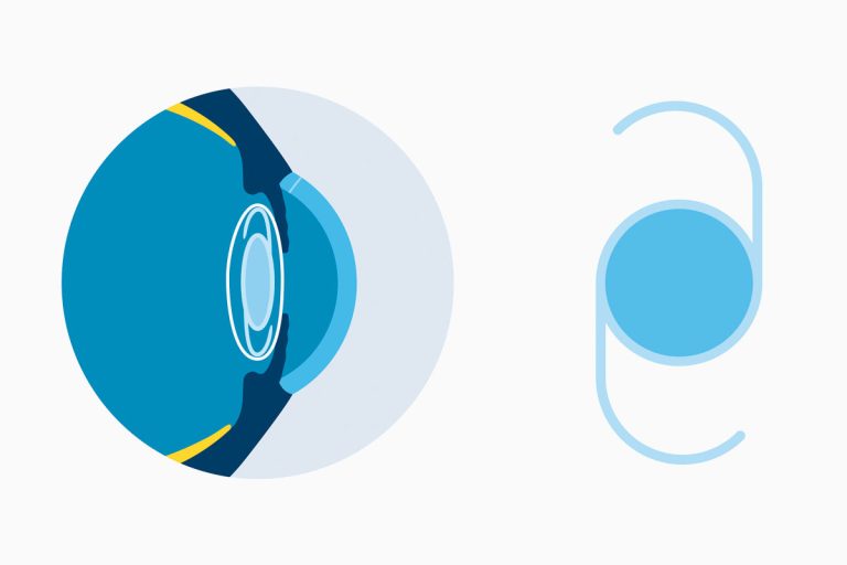 Lentes intraoculares para pacientes con cataratas monoculares