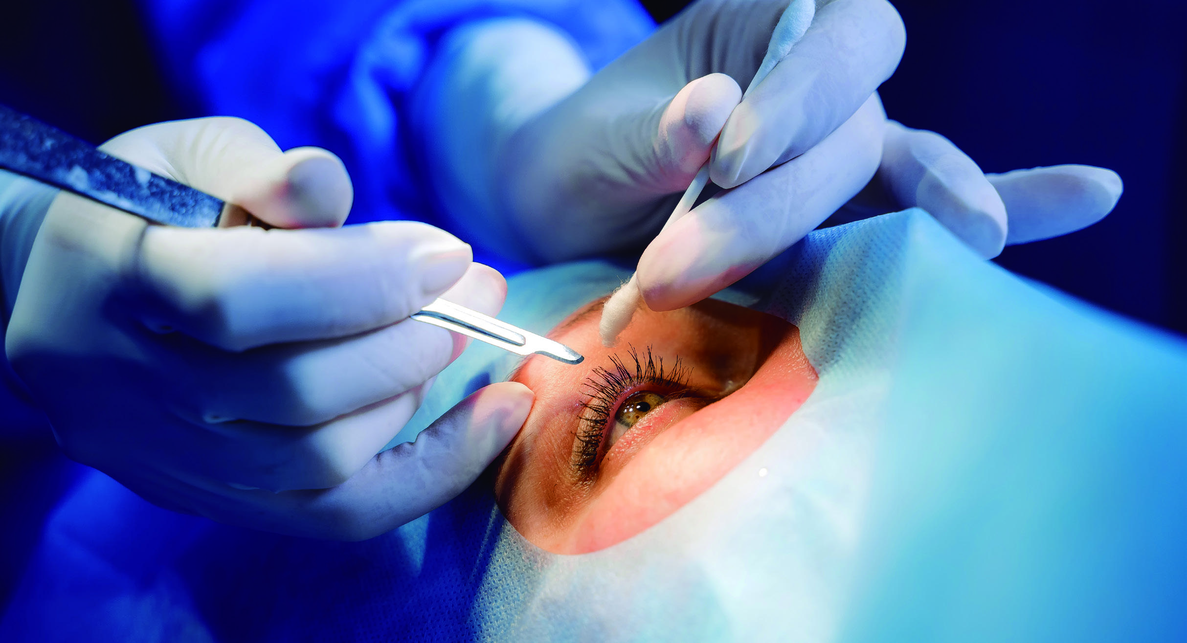 Guía sobre la cirugía del agujero macular